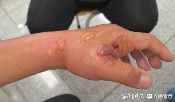景盛配资 被鱼刺扎了一下险丧命！青岛市市立医院精准治疗为患者保全五指